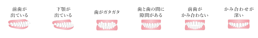 前歯が出ている・下顎が出ている・歯がガタガタ・歯と歯の間に隙間がある・前歯がかみ合わない・かみ合わせが深い