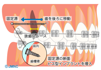 歯科矯正用アンカースクリューを用いた治療